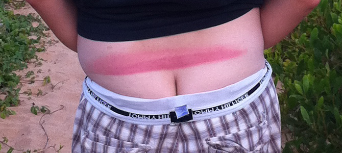 Tramp Stamp Sunburn